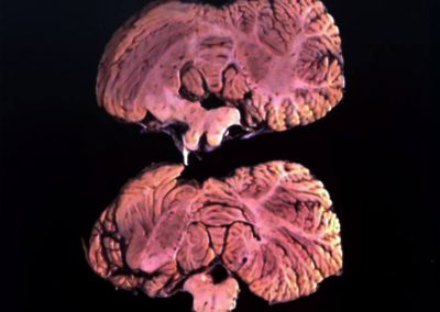 Brain from Kuru-infected Fore